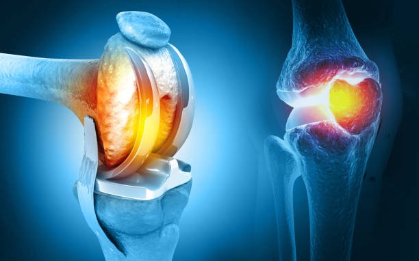 Who Is the Best Joint Surgeon Specializing in Knee Replacement in India?