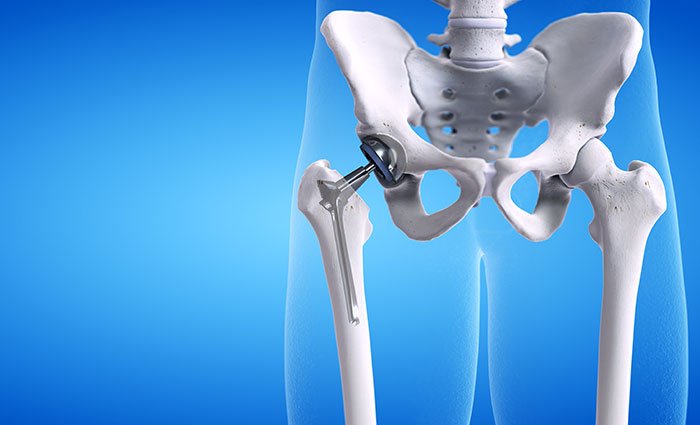 Walking Towards Comfort: The Best Hip Replacement Hospitals in India